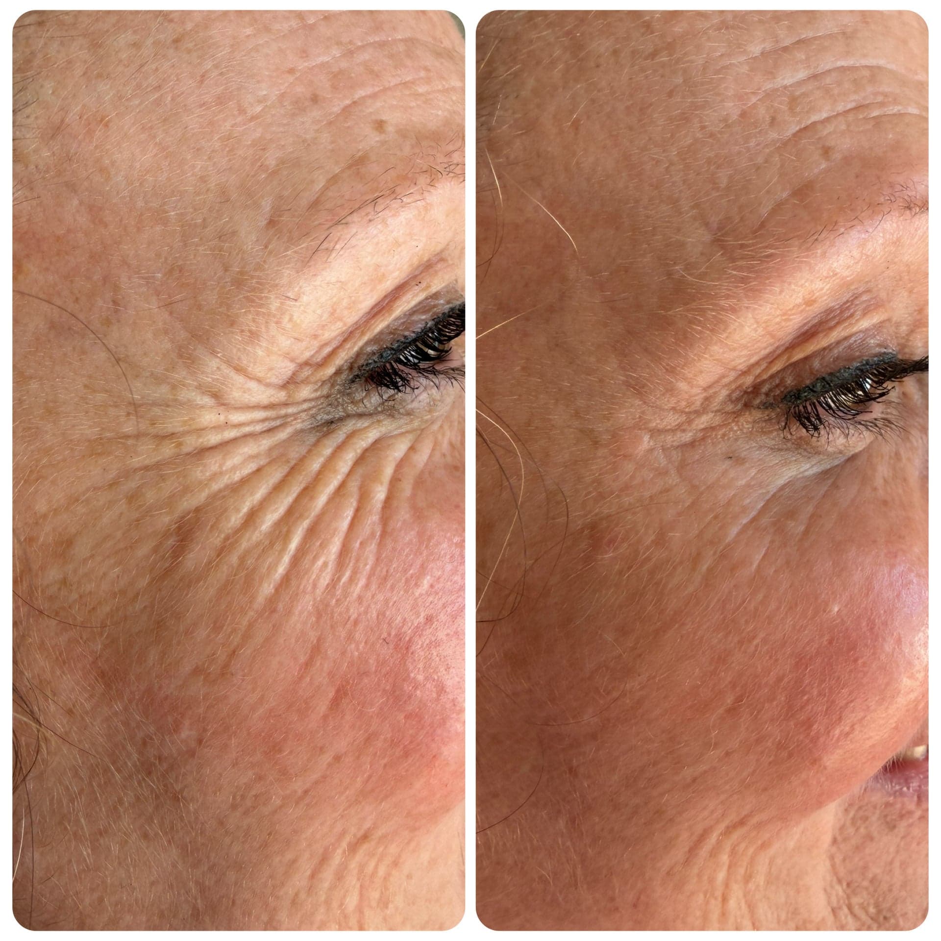 Before and after, crow's feet.