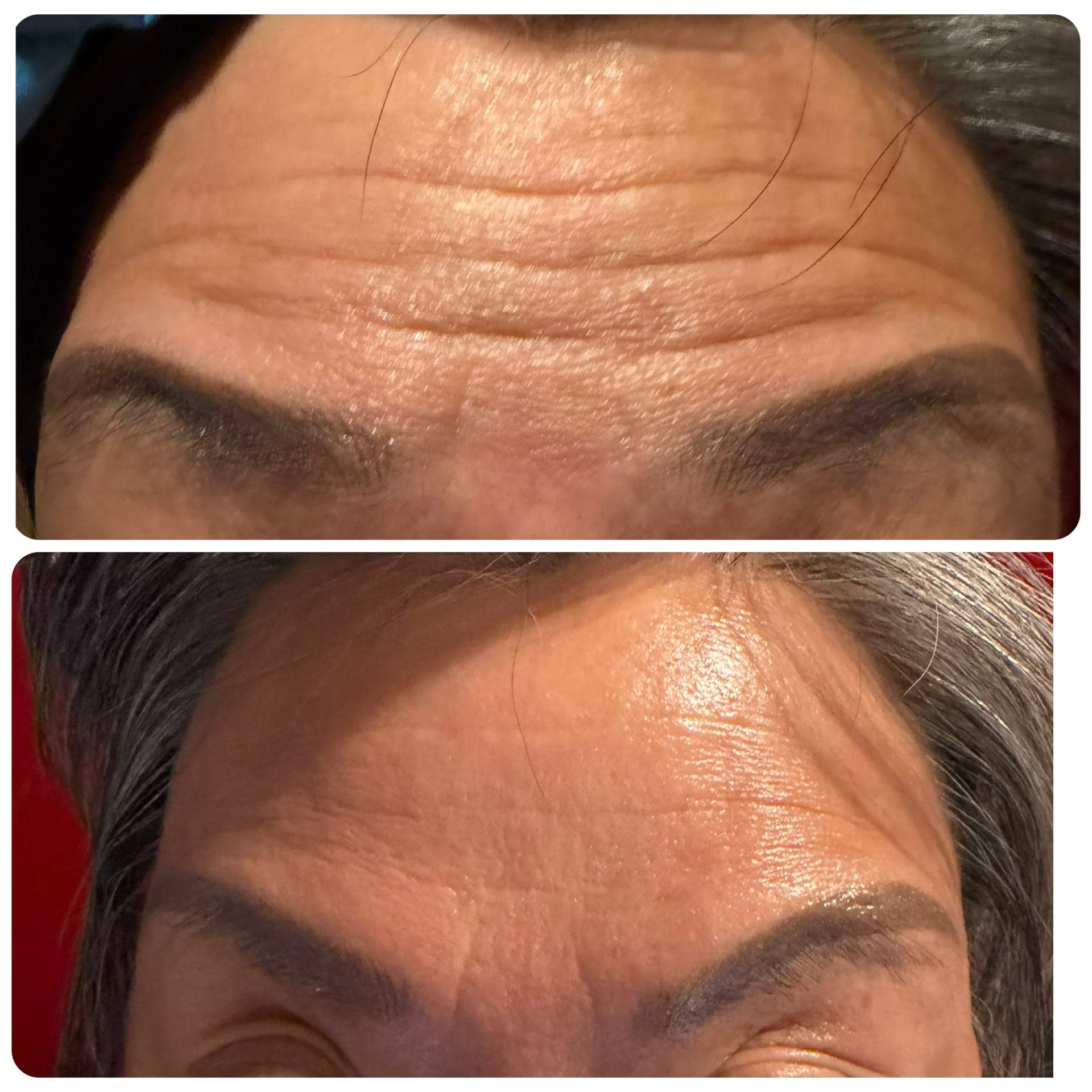 Before and after, forehead lines.