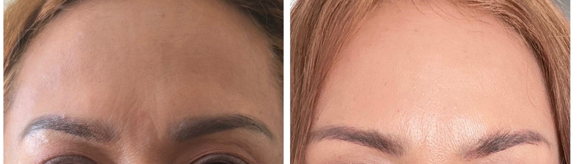 Before and after, forehead lines.